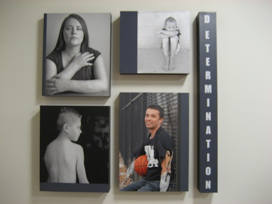 Pictures of former patients line a hallway at the U of U Burn Center